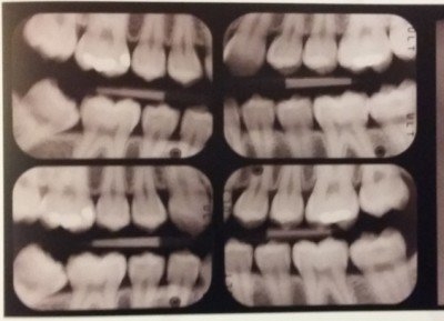 Esempio di radiografie bitewing necessarie per diagnosticare la presenza di carie.