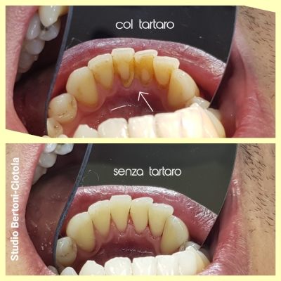 Prima e dopo la rimozione del tartaro